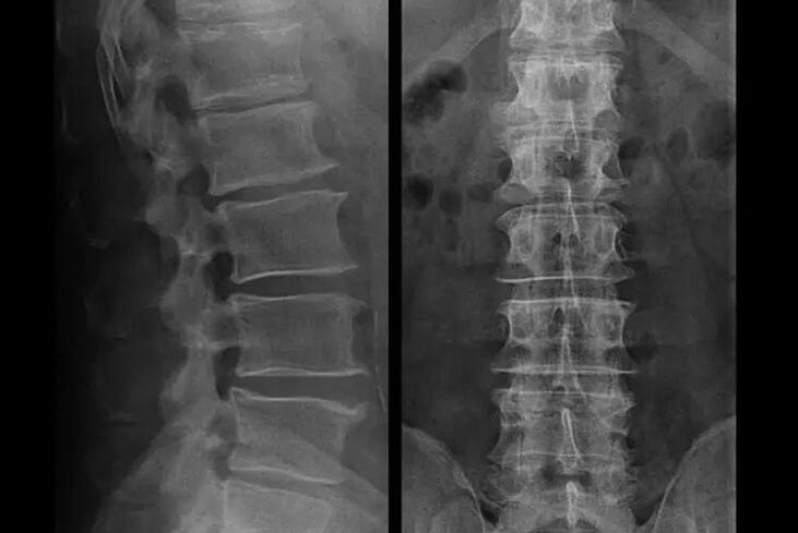 Osteocondrose en raios X