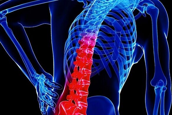Os motivos do desenvolvemento da toraxosteocondrose
