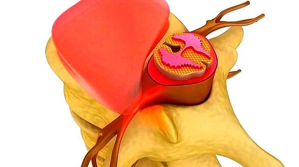 Osteocondrose da columna torácica a esencia da enfermidade