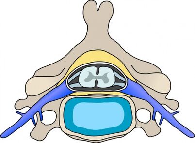 Protabius en vértebras con osteocondrose cervical